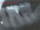 Webinar: The LANAP Protocol: Evidence-based Laser Periodontitis Treatment