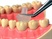Occlusal Clearance Devices