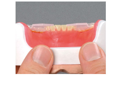 Step 2 - check the correct position of the grips in horizontal alignment with the chewing level and wax the teeth in firmly.
