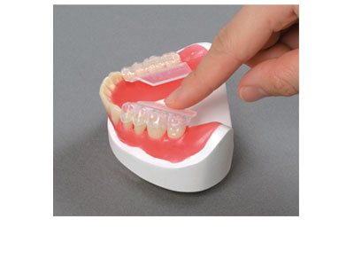 Step 3 - A little bit of pressure on the grip releases the setup. Finally, close the interdental spaces with wax