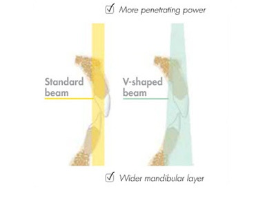 Benefits of V-Shaped Collimation