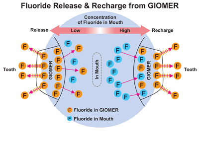 Fluoride release & recharge