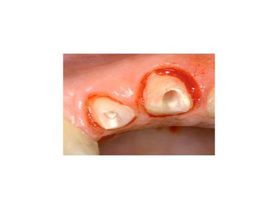 Blood is Common in Any Procedure Near or Below the Gumline.