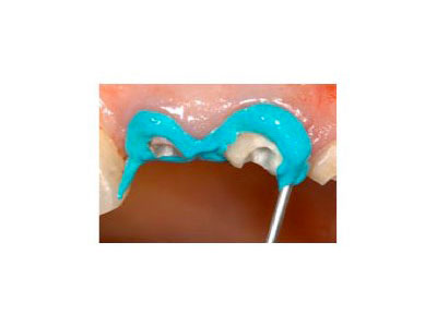 Placement is Easy and Efficient With 2 g Syringe. Use Only What  You Need. No Agitation Required.