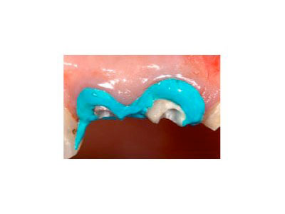Unique Consistency Acts as a Mechanical Dressing. Stays in Place, No Dripping. Contrasting Blue Color is Easy to See.