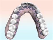 New Dental Product: INBRACE Braces from Swift Health Systems