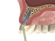 New Dental Product: EZ-Base Abutment from MIS Implants