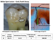 Research Finds The Canary System Accurately Measures Caries Lesion Volume and Depth