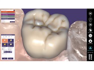 exocad’s ChairsideCAD Software Solution Now Available