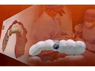 Glidewell Laboratories Now Offers Surgical Guides With Digital Treatment Planning Service