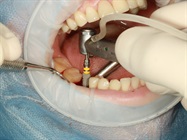 Commoditization Won't Stall U.S. Dental Implant Market Growth