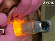 Watch Video: Zyris - Dental Implant Procedure with ISOLITE 3