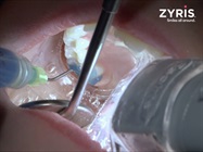 Watch Video: Isolite® 3 Sealant