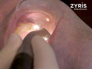 Watch Video: Zyris - ISOLITE<sup>®</sup> 3 and Crown Preparation