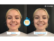 New Dental Product: SmileView from Align Technology