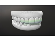 Align Technology Introduces Invisalign G8 with SmartForce Aligner Activation