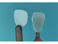 New Dental Product: UltraThineer 3D Printed Veneers From Boston Micro Fabrication
