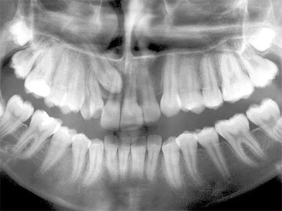 Dental Panoramic Film