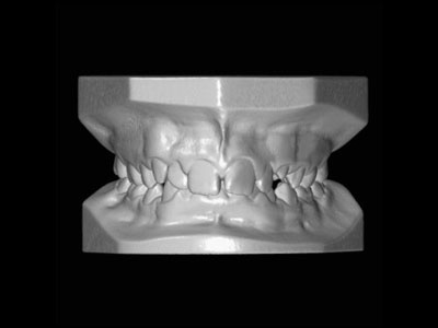 Orthodontic 3D Digital Modeling